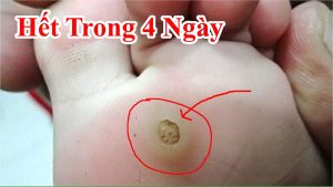 Cách trị mụn cóc đơn giản 4 ngày là biến mất hoàn toàn - mẹo trị mụn cóc mọc ở chân hiệu quả bằng tỏi