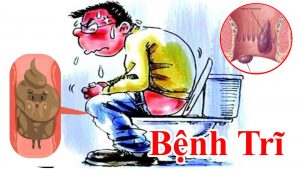 Cách trị bệnh trĩ rất hiệu quả , đã có nhiều người làm hết rồi ! Bài thuốc trị trĩ nội , trị trĩ ngoại tại nhà