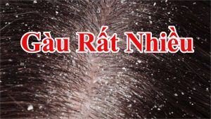 5 Cách làm sạch gàu hiệu quả cho những ai cần - Cách trị gầu , ngứa đầu , trị sạch gàu trên đầu tóc