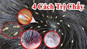 Cách diệt chấy rận tóc tận gốc không còn 1 con nào - mẹo trị trứng chấy trên tóc hiệu quả tại nhà - diệt con chí con tri tóc