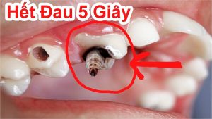 cách trị đau răng hiệu quả trong 3 phút là hết - cách trị nhức răng hiệu quả cho trẻ nhỏ tại nhà