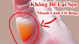 Cách giúp vết bỏng không đau rát và không để lại sẹo , nhanh lành vết thương cực hay bạn biết