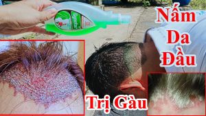 Cách trị gàu rất hiệu quả 100% - Ngứa đầu , trị nấm da đầu triệt để - Bài thuốc trị nấm da đầu có vẩy nến trắng gây ngứa đầu