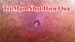 Cách trị nhọt cực hiệu quả và dễ làm - Mẹo trị mụn nhọt ở nhà với những mẹo vặt dưới đây